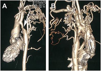 Delayed Therapy of Descending Aortic Coarctation Results in Anterior Cerebral Rupture: A Case Report